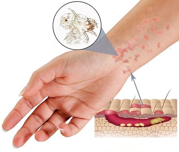 Scabies flea pests under the skin